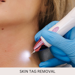 Skin Tag Removal (1-5)