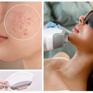 The Power of IPL Technology for Acne